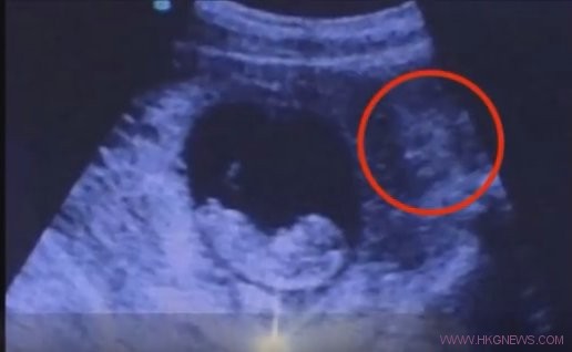 詭異！這張胎兒超聲波顯示子宮外驚現”魔鬼”面